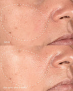 Pro MelanoPro Peeling System 4pk