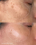 Pro MelanoPro Peeling System 4pk